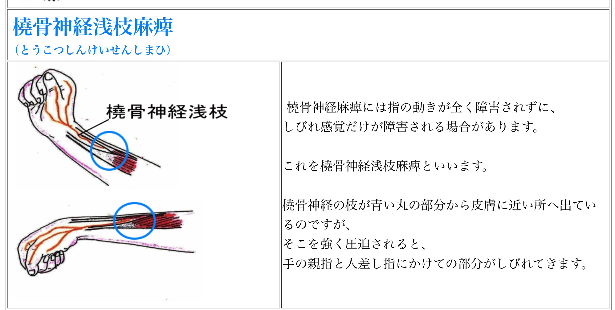 神経 麻痺 こつ とう 猿手・鷲手・下垂手（正中神経麻痺・尺骨神経麻痺・橈骨神経麻痺で生じる）をイラスト付きで紹介